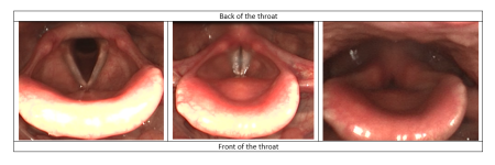 Three photos of vocal chords